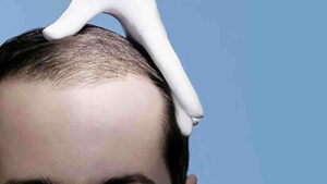 Pourquoi une greffe de cheveux en Turquie?