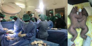 Sénégal : l'une des sœurs siamoises séparées est décédée