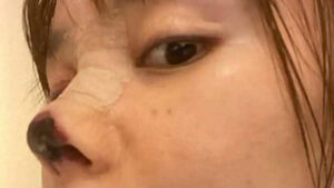 Chirurgie du nez : une actrice défigurée après une opération