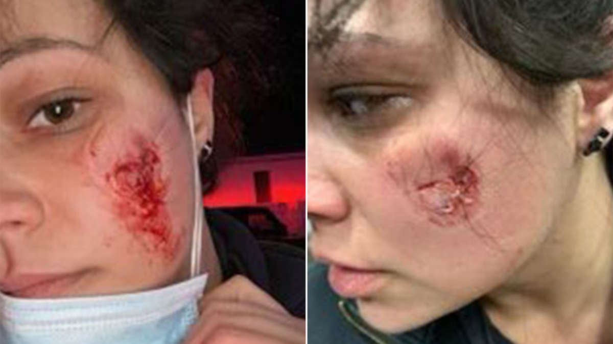 Une ambulancière mordue au visage par une patiente raconte sa mésaventure