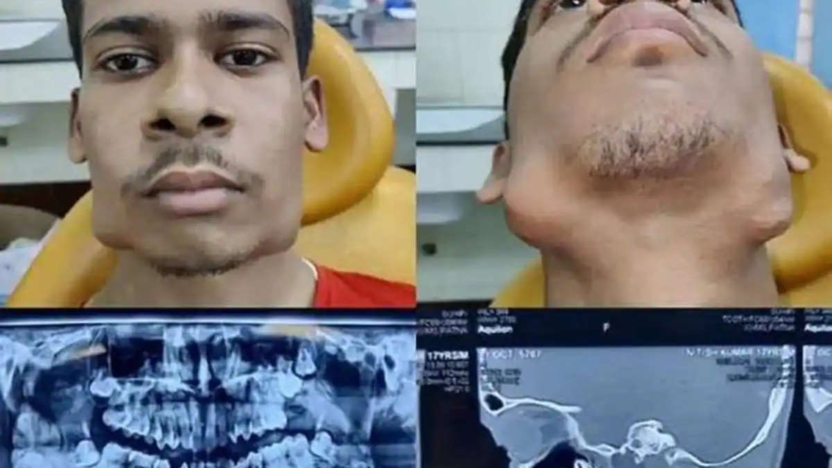 Inde : un adolescent se fait retirer 82 dents (qui étaient dans une tumeur)
