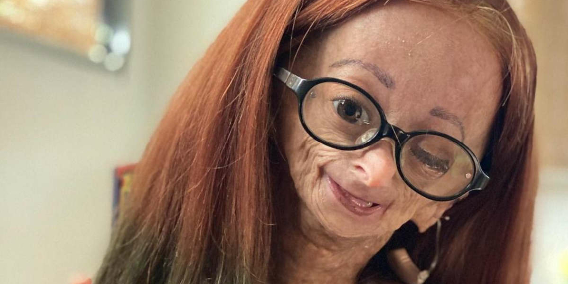 Adalia Rose Williams Décès à 15 Ans De La Youtubeuse Atteinte De Progéria La Nouvelle Tribune