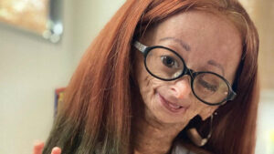 Adalia Rose Williams : décès à 15 ans de la youtubeuse atteinte de progéria