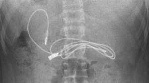 Un câble USB retiré de l'estomac d'un ado de 15 ans