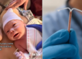 Insolite: un bébé naît avec le sterilet de sa mère en main