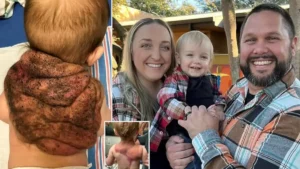 Insolite: ce bébé nait avec une "carapace" sur le dos, voici ce que ses parents ont fait