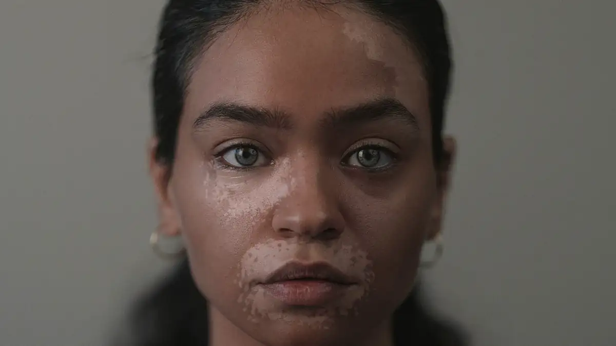 Vitiligo: un traitement enfin validé en Europe