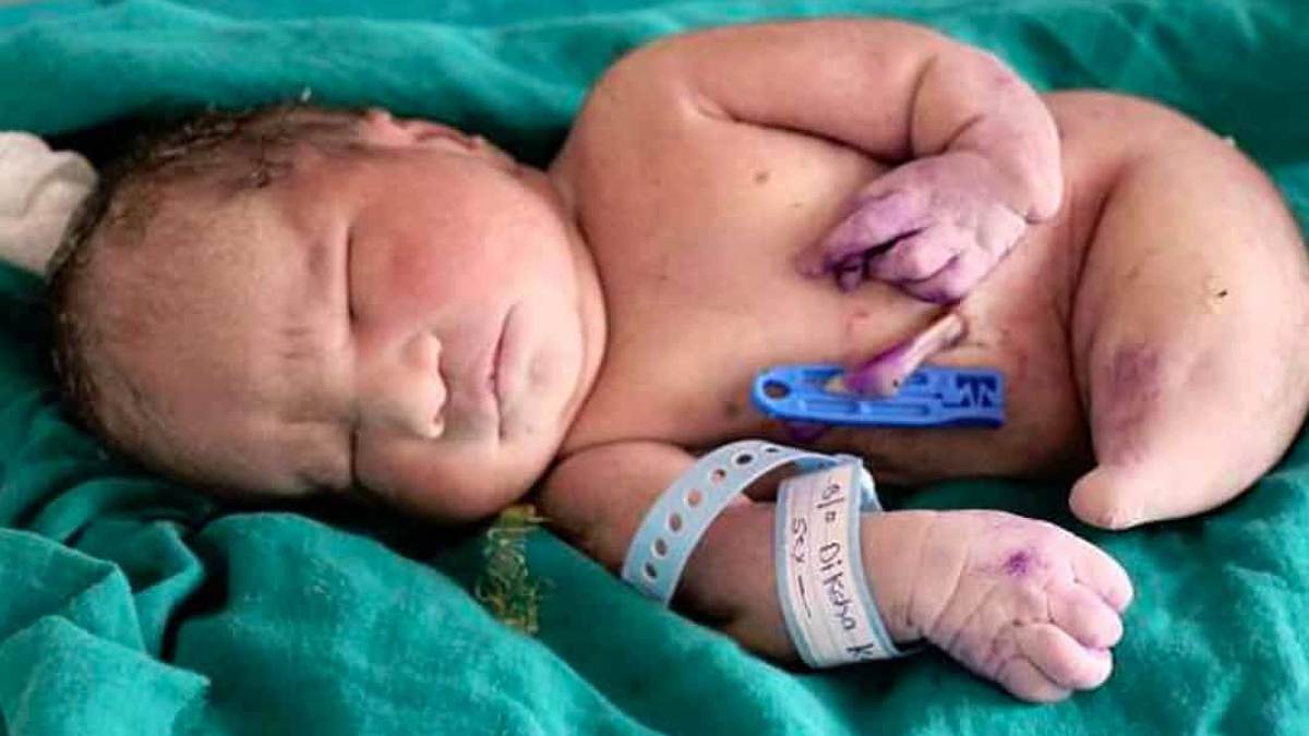 Un bébé naît avec le «syndrome de la sirène»