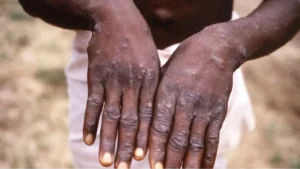 Maghreb : la variole du singe signalée dans ce pays