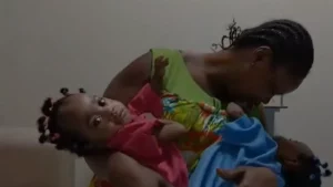 Côte d'Ivoire: la séparation de soeurs siamoises émeut le pays