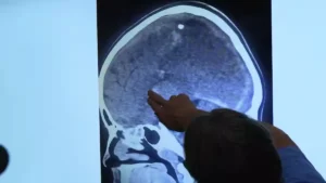 Flèche au cerveau: Cet enfant de 9 ans échappe à la mort