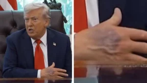 Ecchymoses de Trump aux États-Unis : l’étrange parallèle avec la reine Elizabeth II