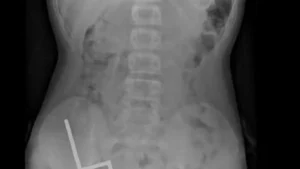 100 aimants retirés de l’abdomen d’un adolescent en Nouvelle-Zélande