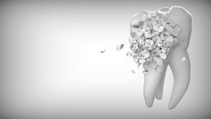 Prix d'un implant dentaire