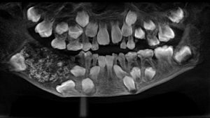 Insolite en Inde : un enfant se fait retirer des centaines de dent de la bouche